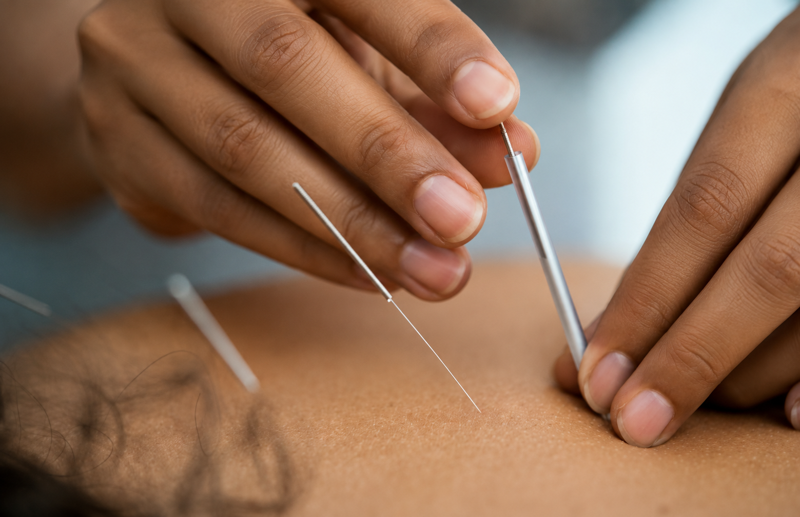 Fine acupuncture needles